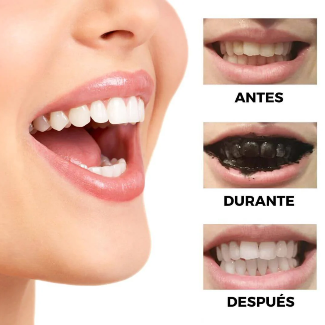 Teeth Whitening - Dientes más blancos en pocos días